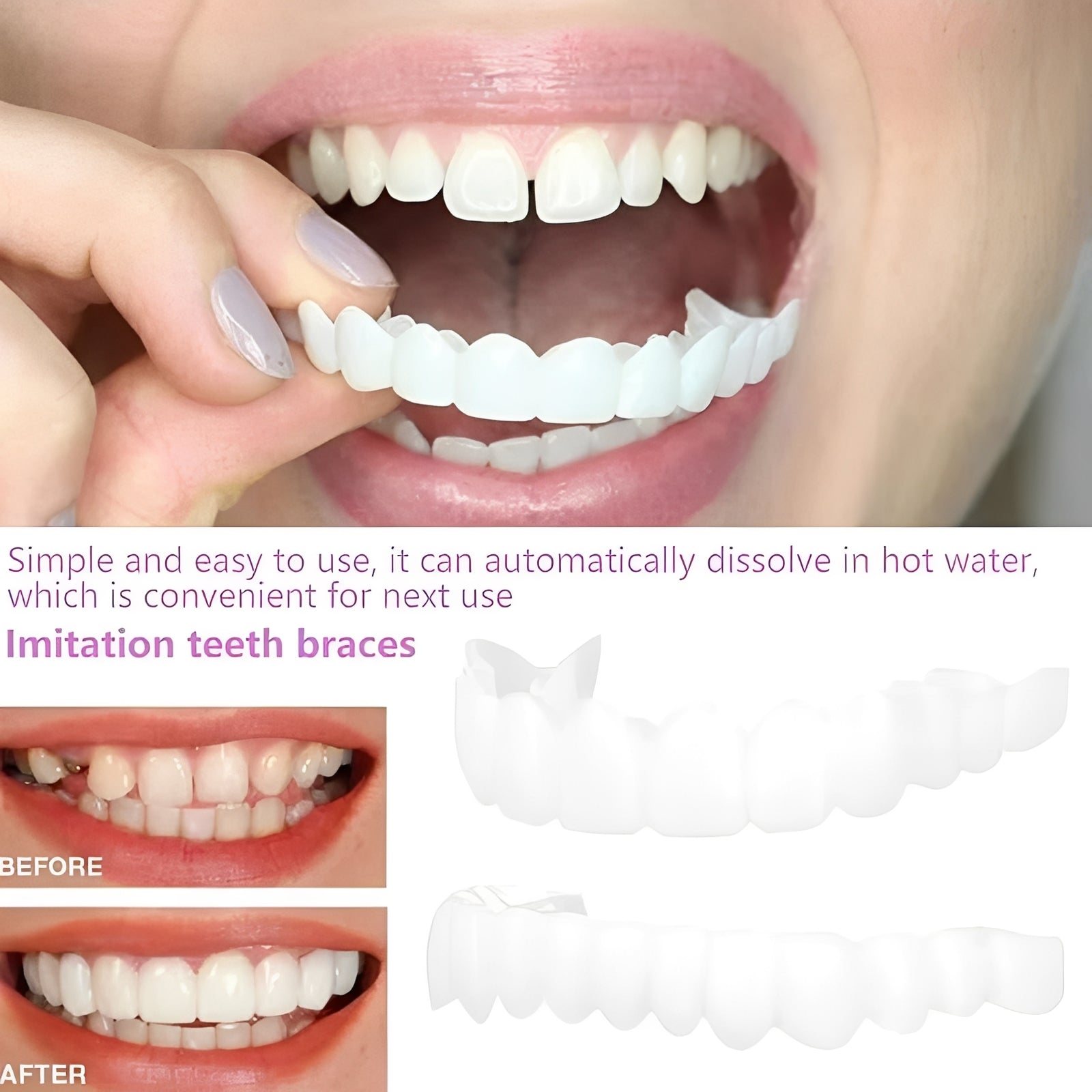 The Instant-Smile Pro: Snap-On Cosmetic Veneers for a Flawless Profile